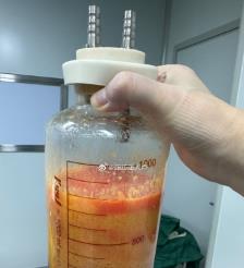 巢湖水动力吸脂手术要做多久？